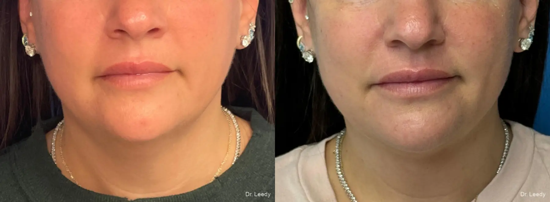 SmartLipo® - Chin: Patient 6 - Before and After  