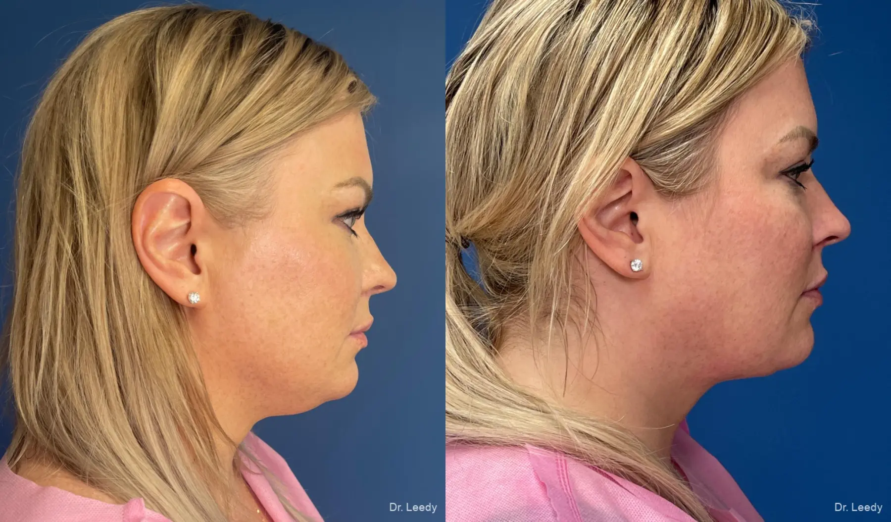 SmartLipo® - Chin: Patient 7 - Before and After  