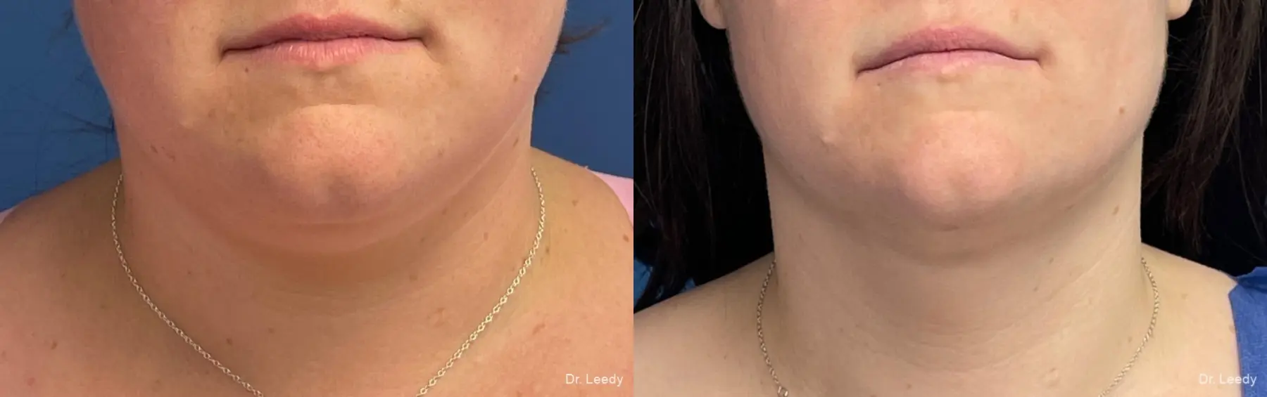SmartLipo® - Chin: Patient 5 - Before and After  