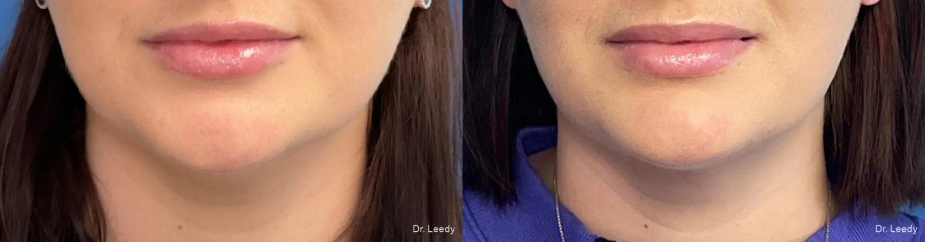 SmartLipo® - Chin: Patient 3 - Before and After  