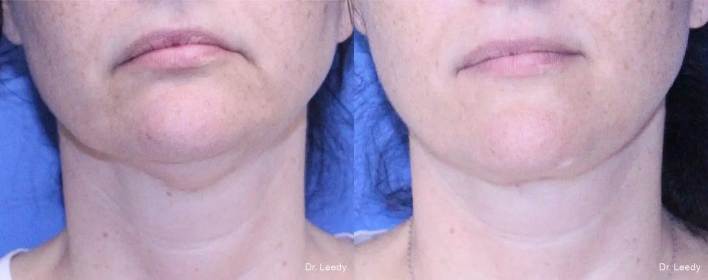 SmartLipo® - Chin: Patient 1 - Before and After  