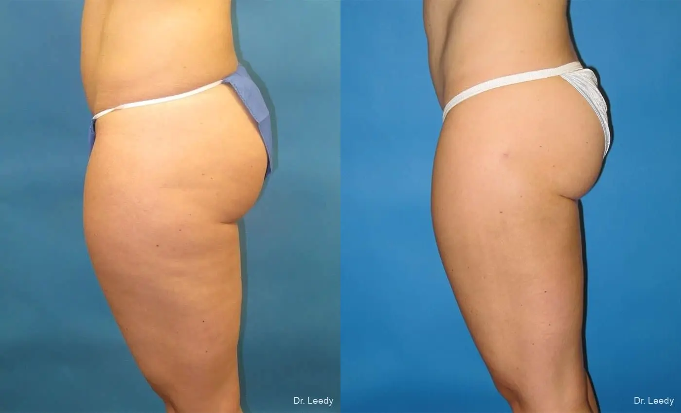 SmartLipo®: Patient 1 - Before and After 5