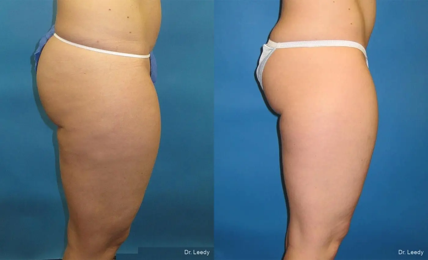 SmartLipo®: Patient 1 - Before and After 3