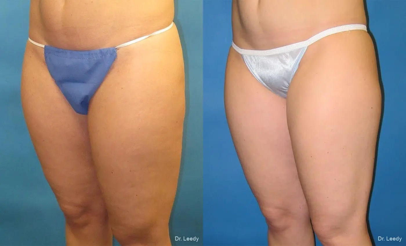 SmartLipo®: Patient 1 - Before and After 4
