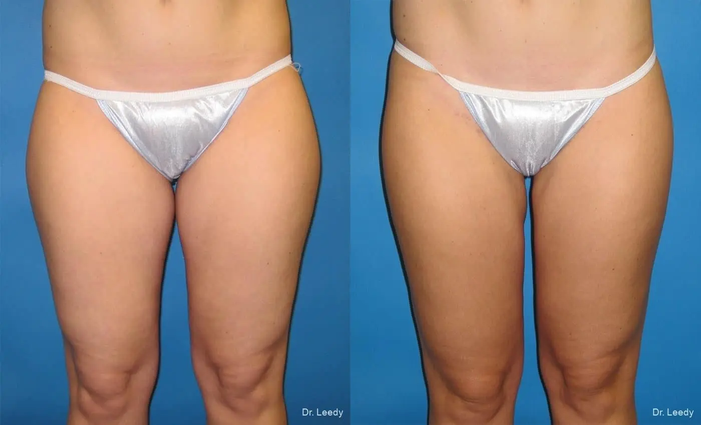 SmartLipo®: Patient 1 - Before and After 1