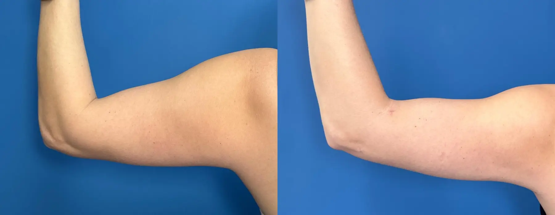 SmartLipo®: Patient 3 - Before and After  