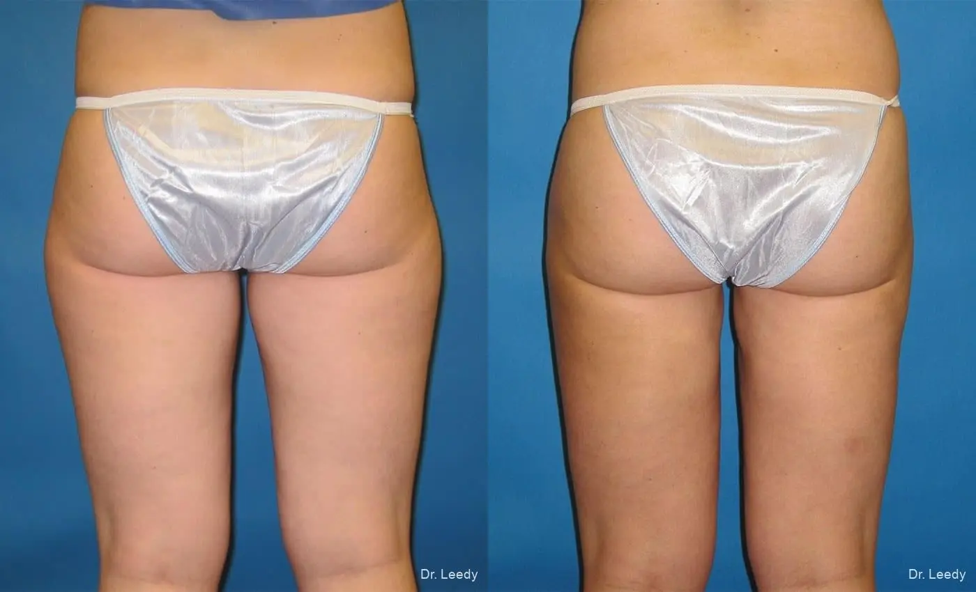 SmartLipo®: Patient 1 - Before and After 6