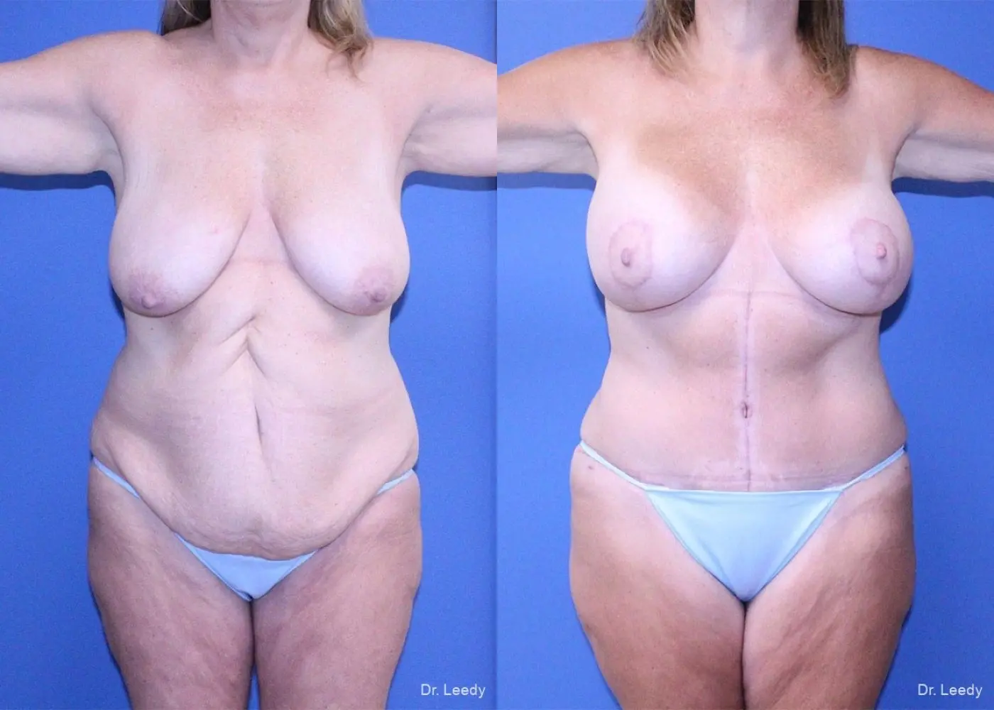 Surgery After Weight Loss: Patient 6 - Before and After 1