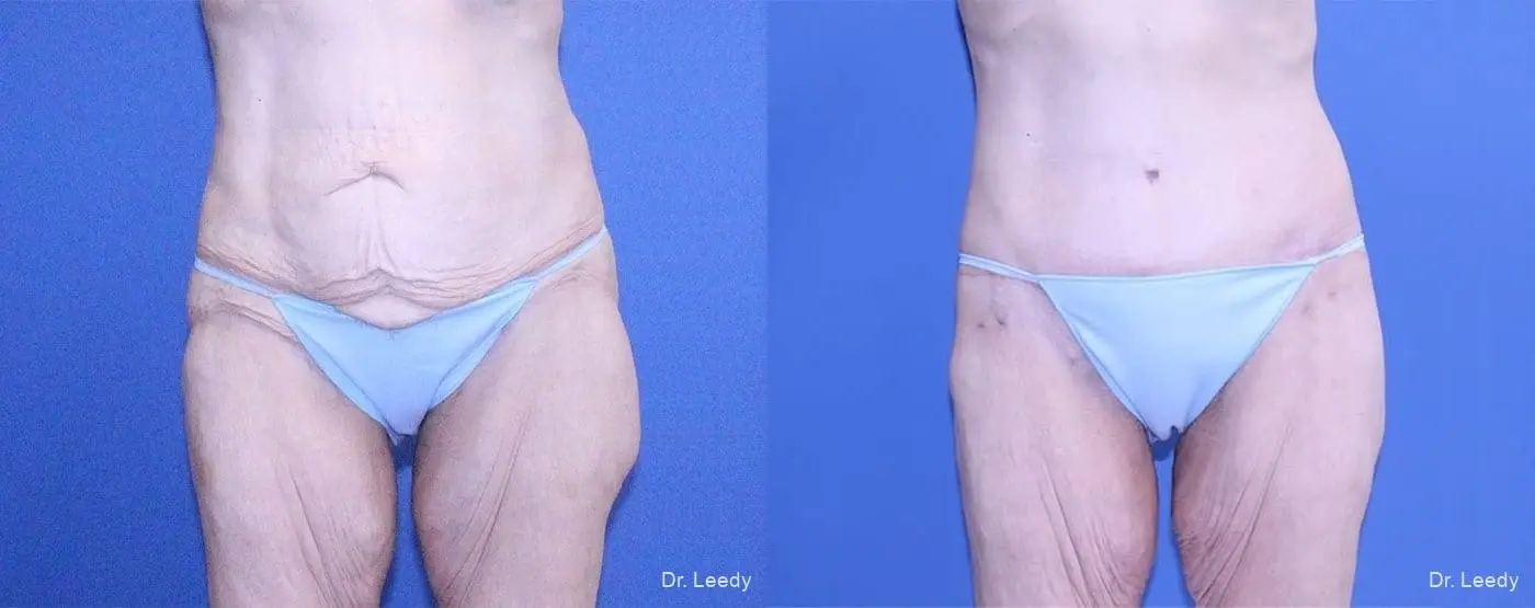 Surgery After Weight Loss: Patient 4 - Before and After 1