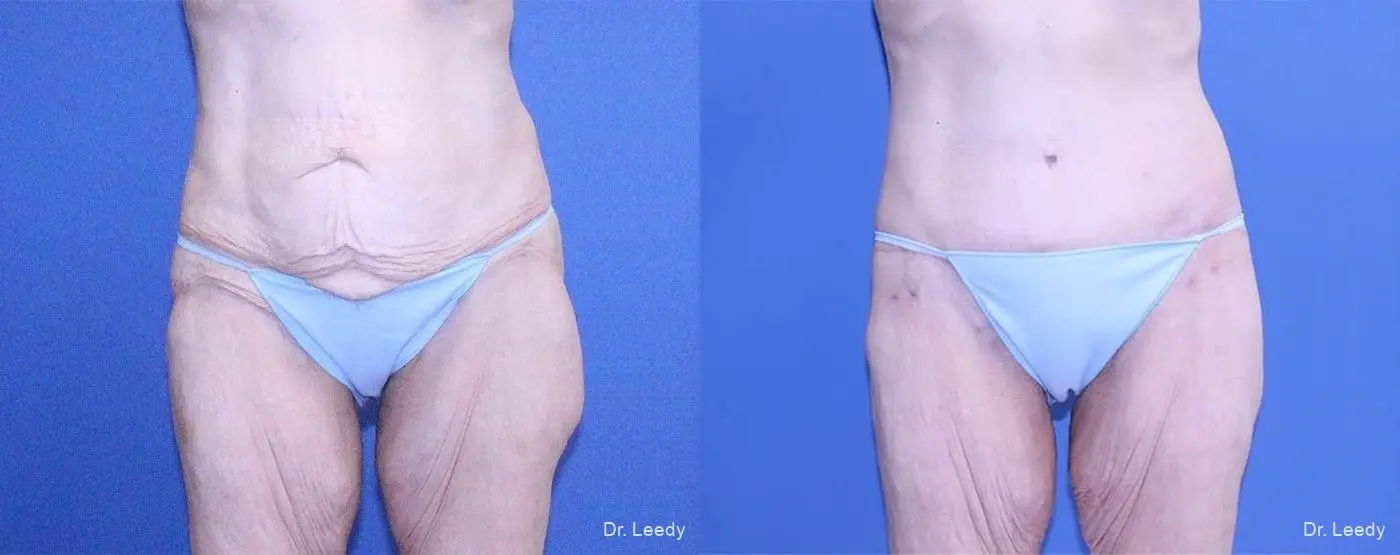 Surgery After Weight Loss: Patient 7 - Before and After  