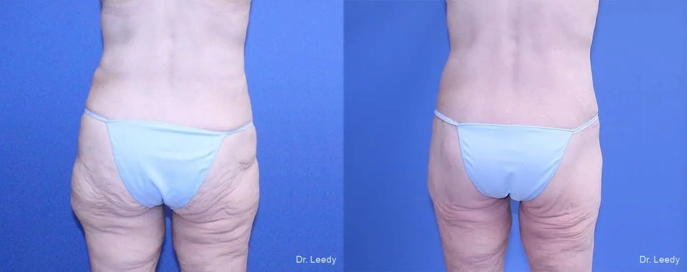 Surgery After Weight Loss: Patient 4 - Before and After 3