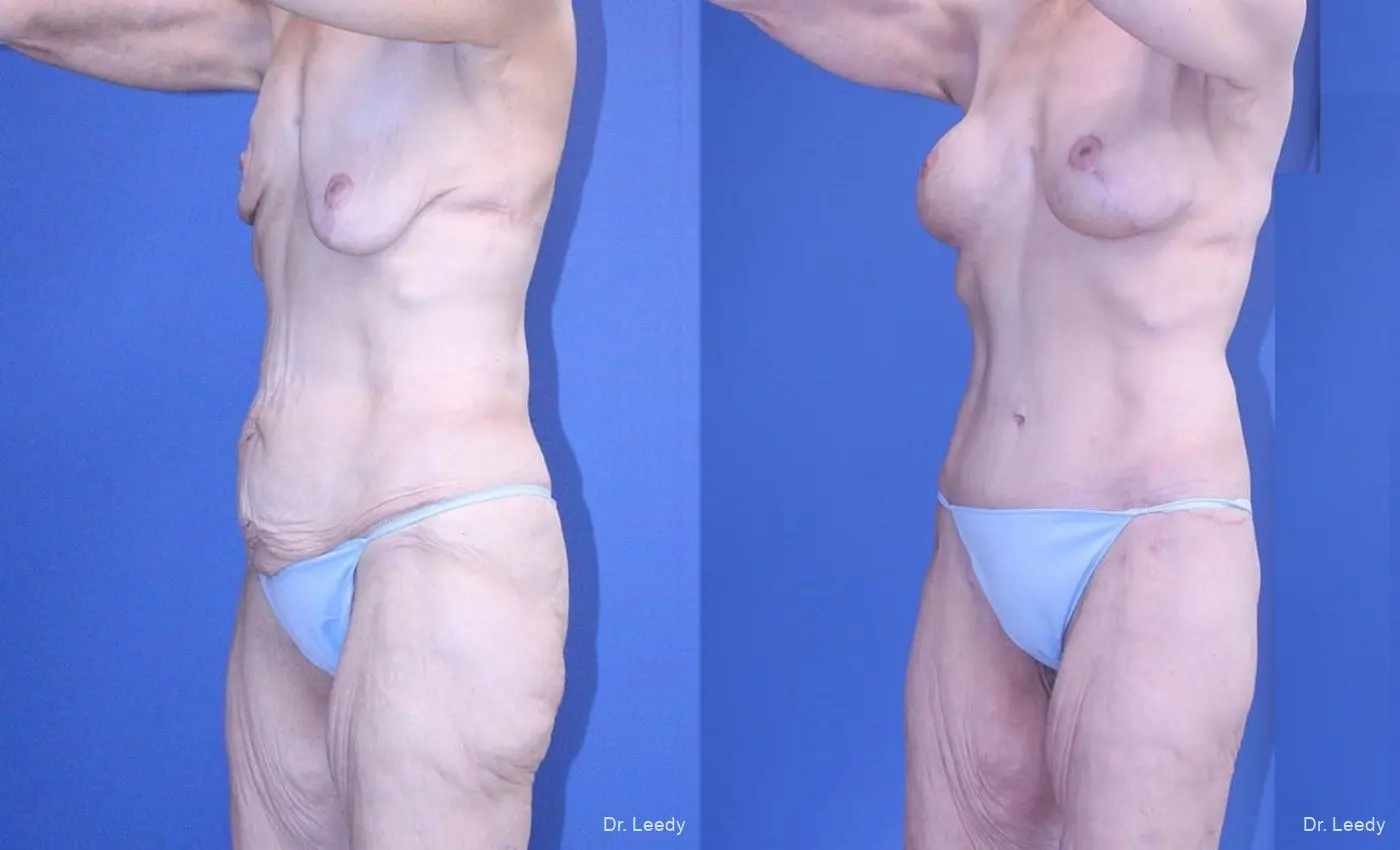 Surgery After Weight Loss: Patient 3 - Before and After 4