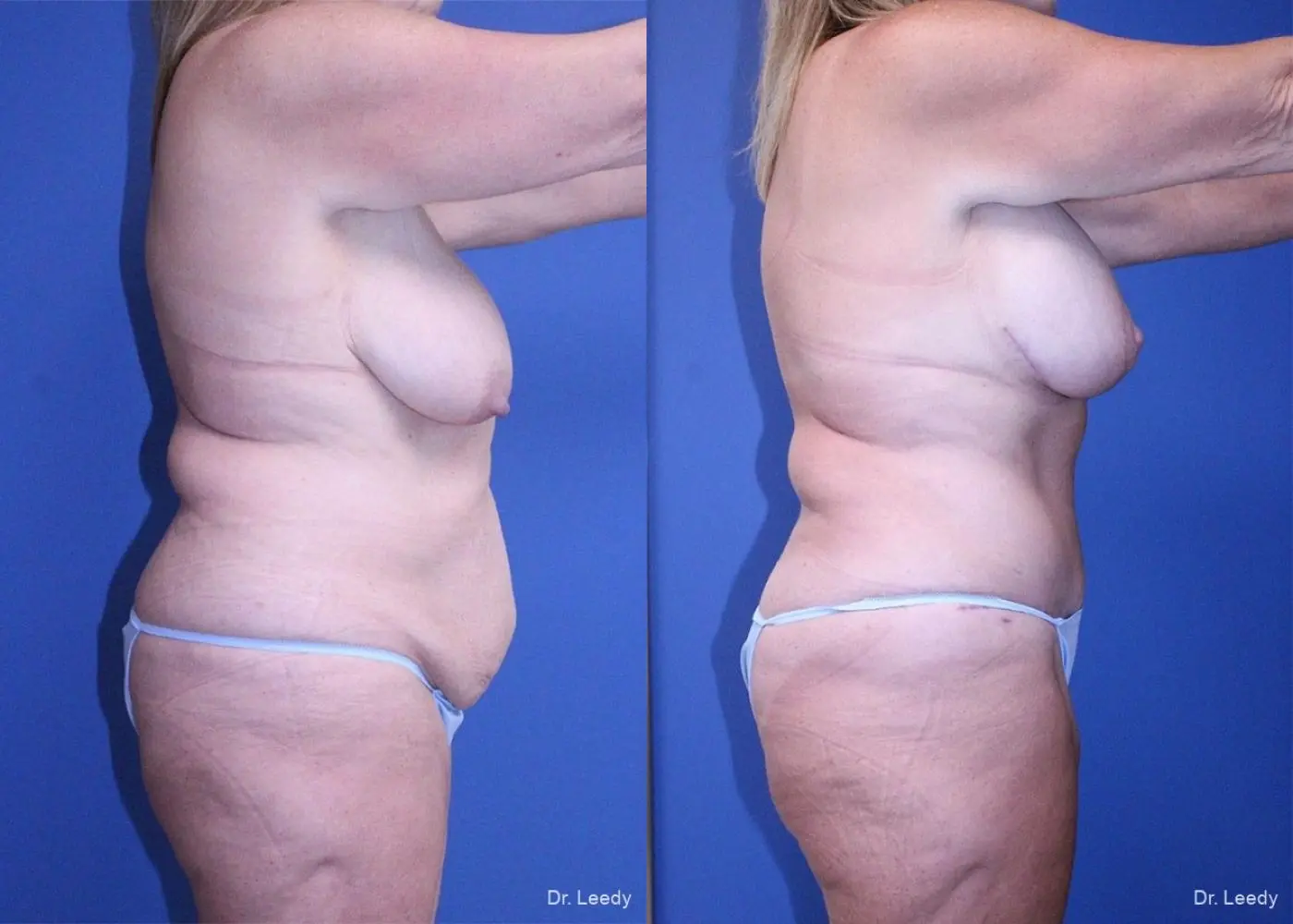 Surgery After Weight Loss: Patient 6 - Before and After 3