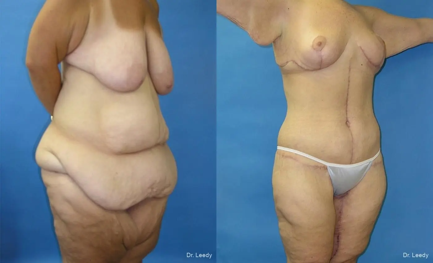 Surgery After Weight Loss: Patient 1 - Before and After 2