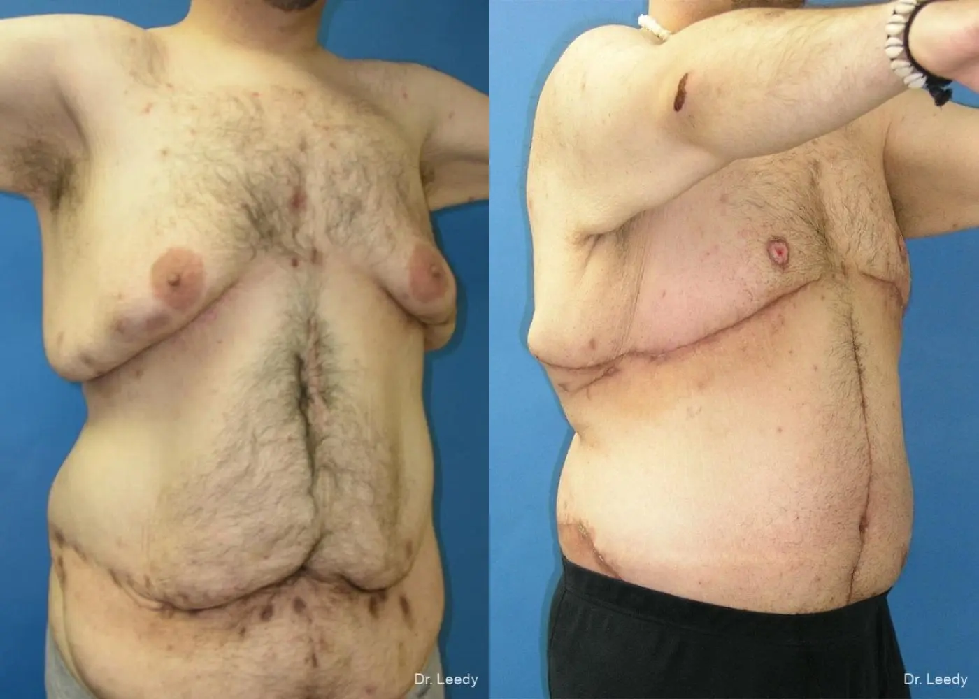 Surgery After Weight Loss: Patient 5 - Before and After 2