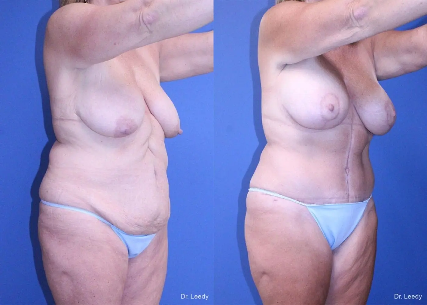 Surgery After Weight Loss: Patient 6 - Before and After 2