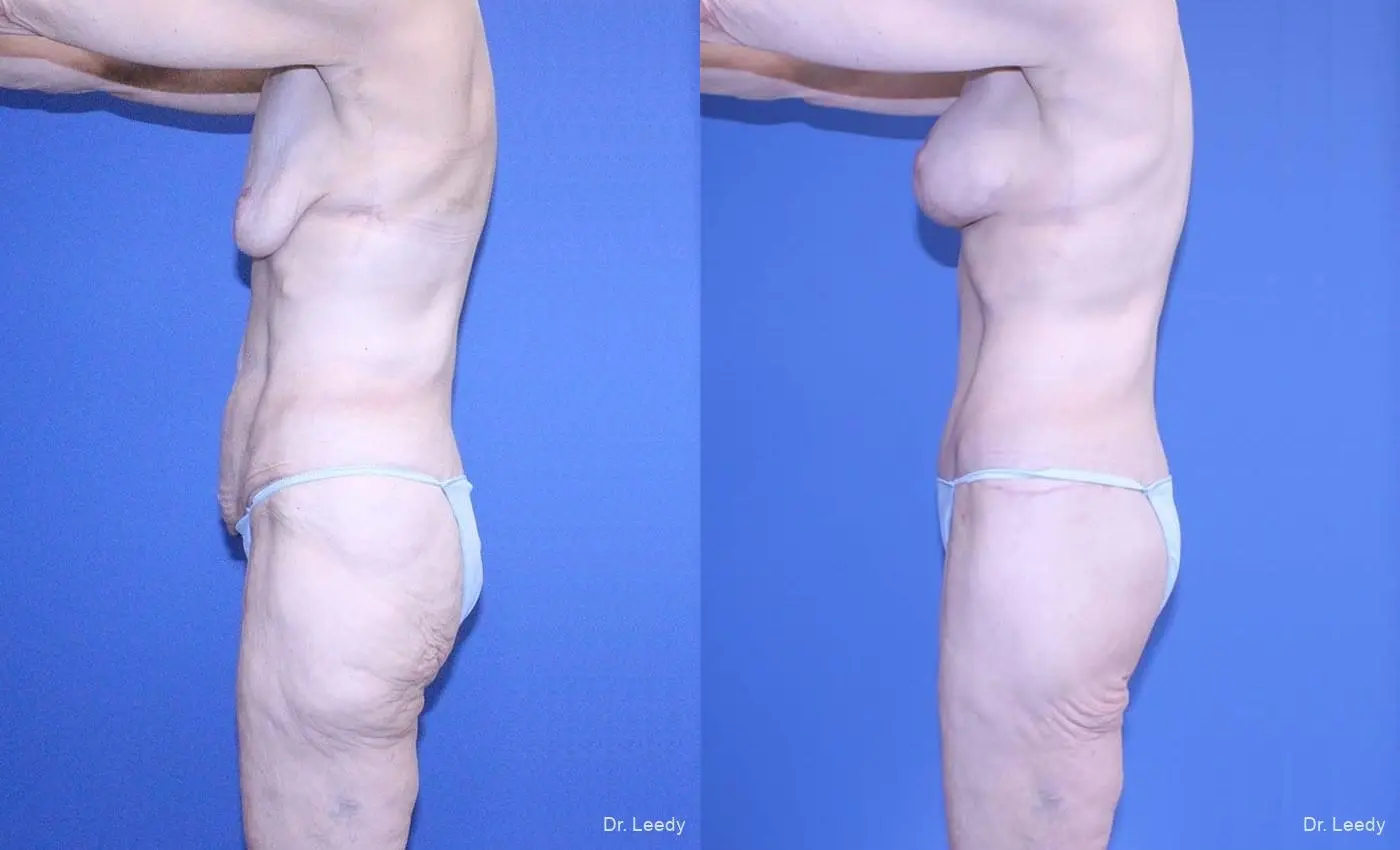 Surgery After Weight Loss: Patient 3 - Before and After 5