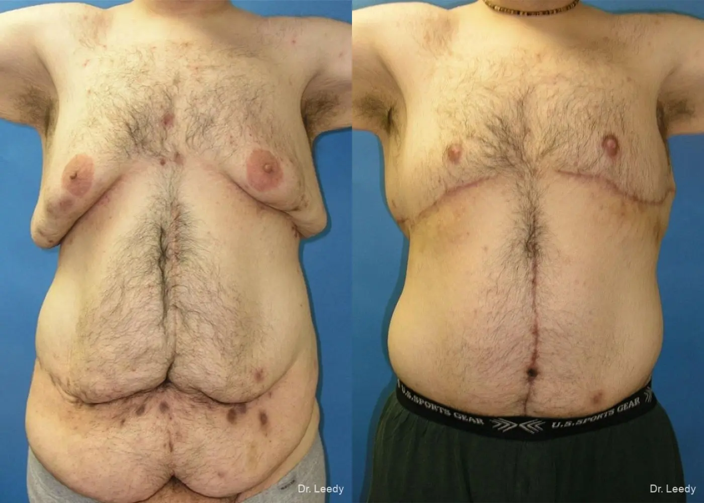 Surgery After Weight Loss: Patient 5 - Before and After 1