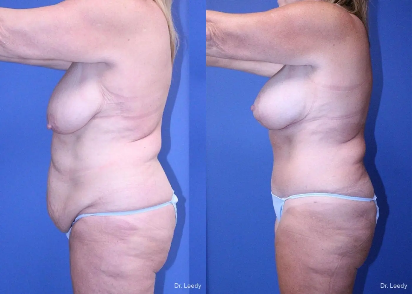 Surgery After Weight Loss: Patient 6 - Before and After 5