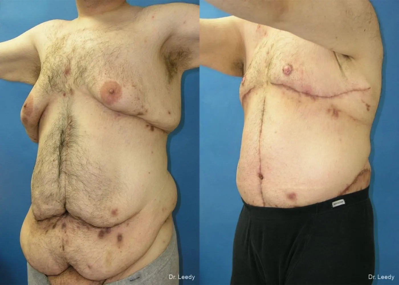 Surgery After Weight Loss: Patient 5 - Before and After 4
