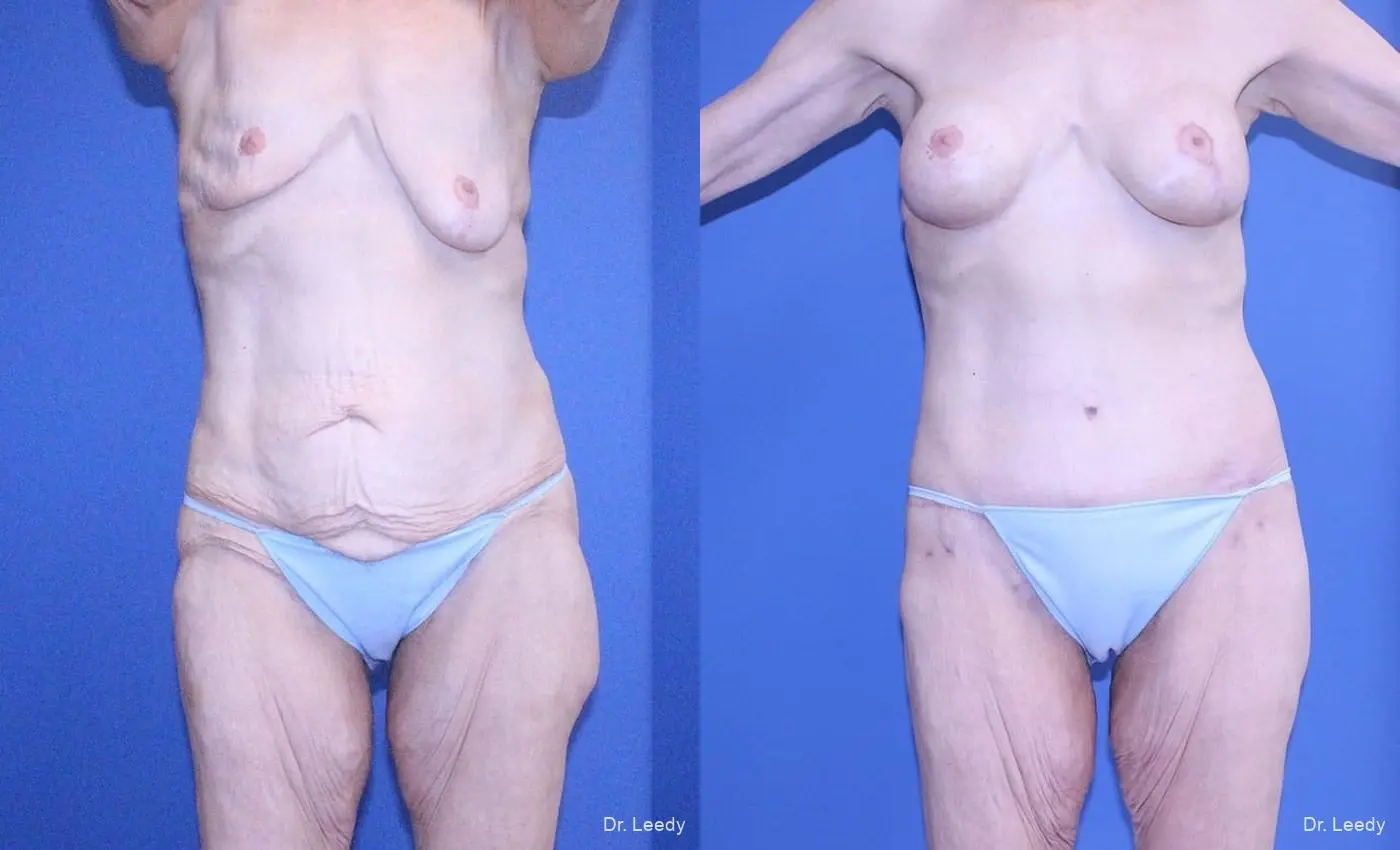 Surgery After Weight Loss: Patient 4 - Before and After  