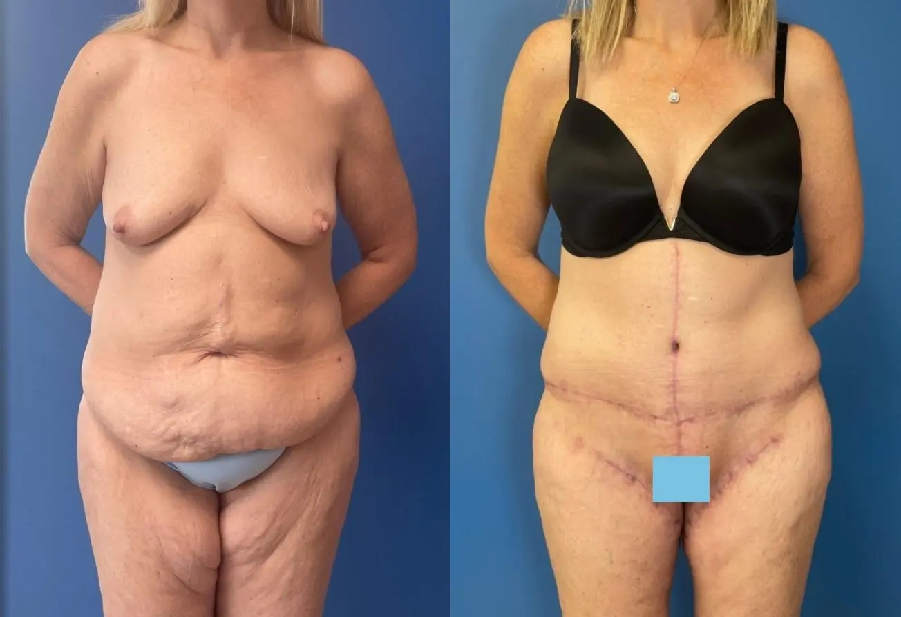 Surgery After Weight Loss: Patient 1 - Before and After  