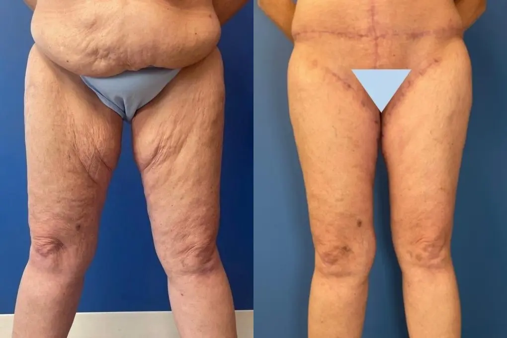 Thigh Lift: Patient 1 - Before and After  