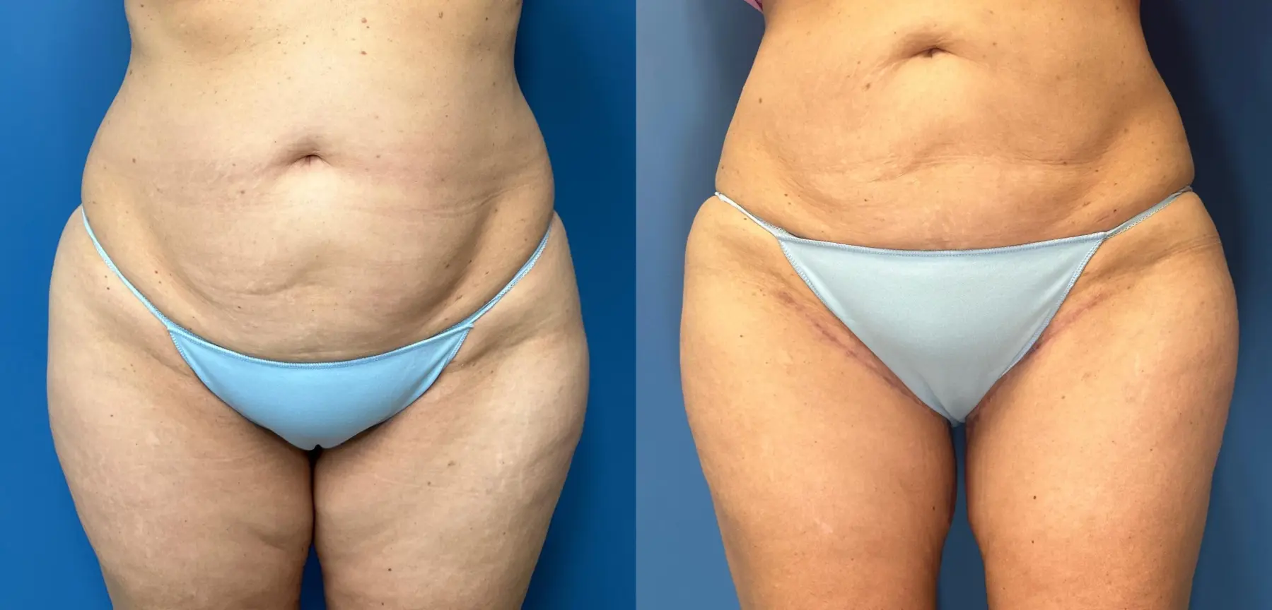 Thigh Lift: Patient 3 - Before and After  