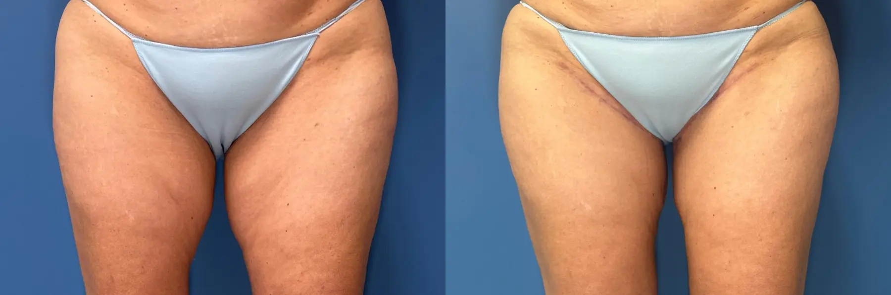 Thigh Lift: Patient 2 - Before and After  