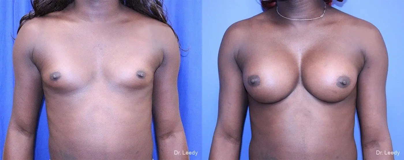 Top Surgery - Male To Female: Patient 1 - Before and After  