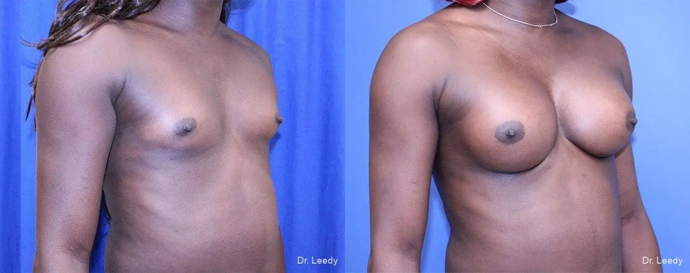 Top Surgery - Male To Female: Patient 1 - Before and After 2