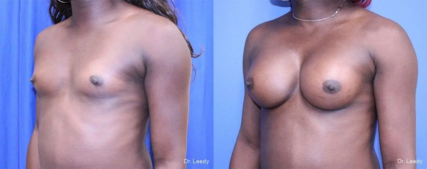 Top Surgery - Male To Female: Patient 1 - Before and After 4