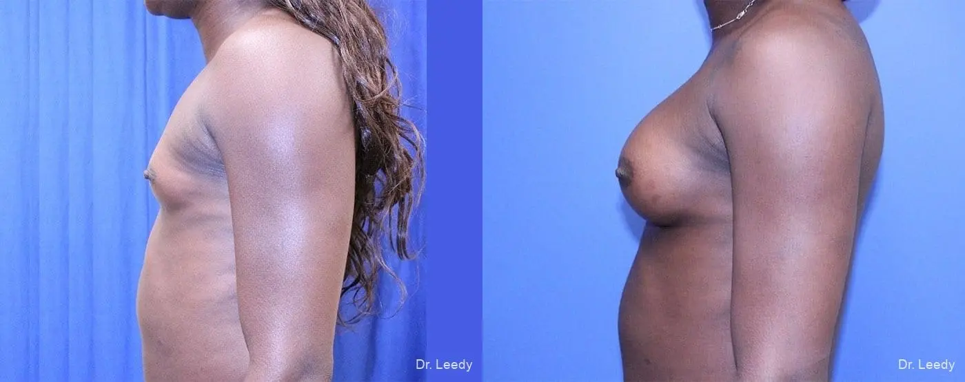 Top Surgery - Male To Female: Patient 1 - Before and After 5