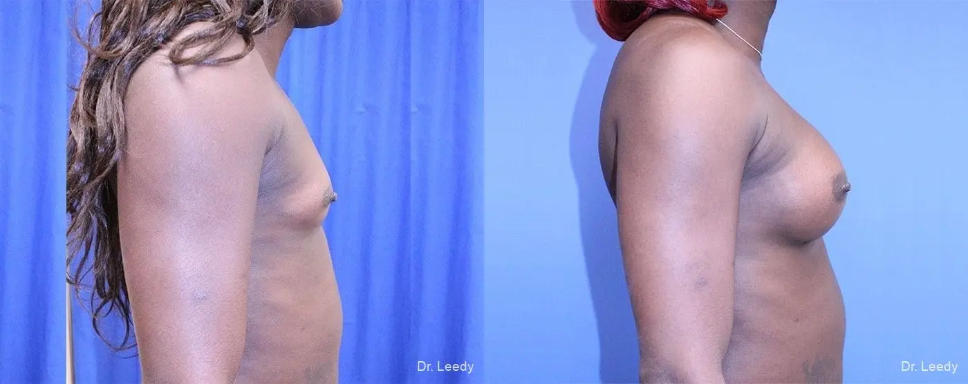 Top Surgery - Male To Female: Patient 1 - Before and After 3