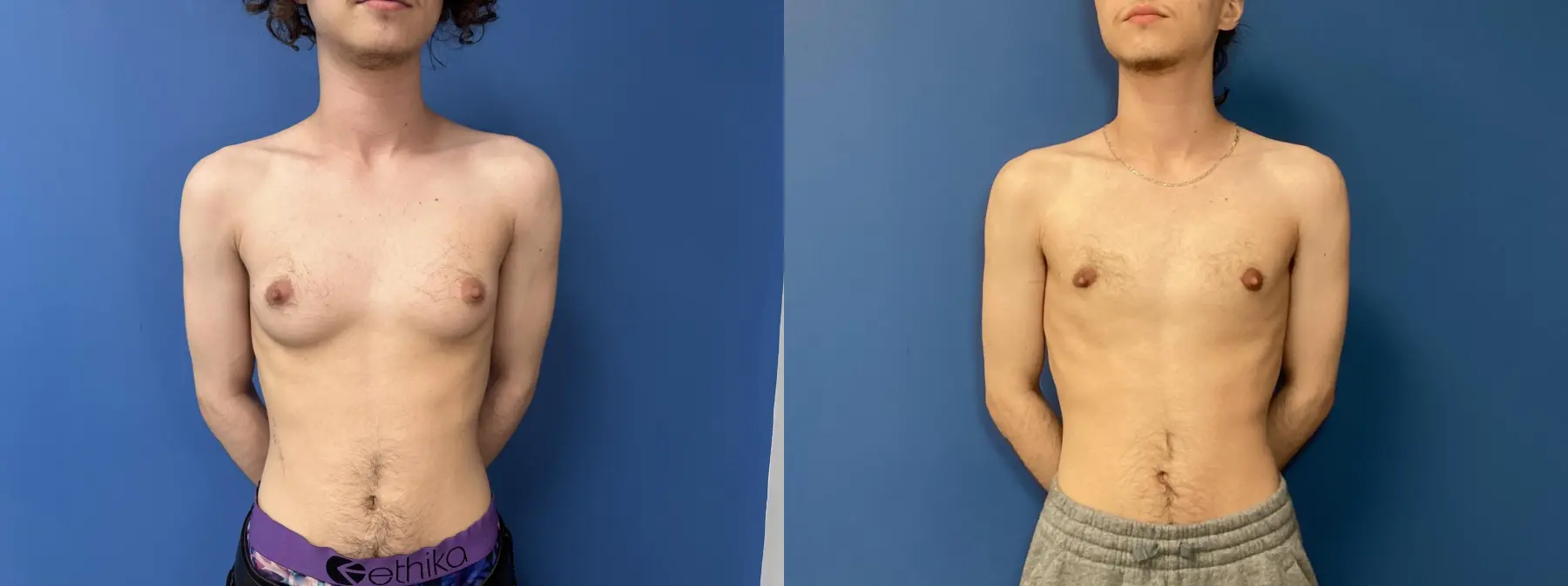 Top-surgery-for-men: Patient 1 - Before and After  
