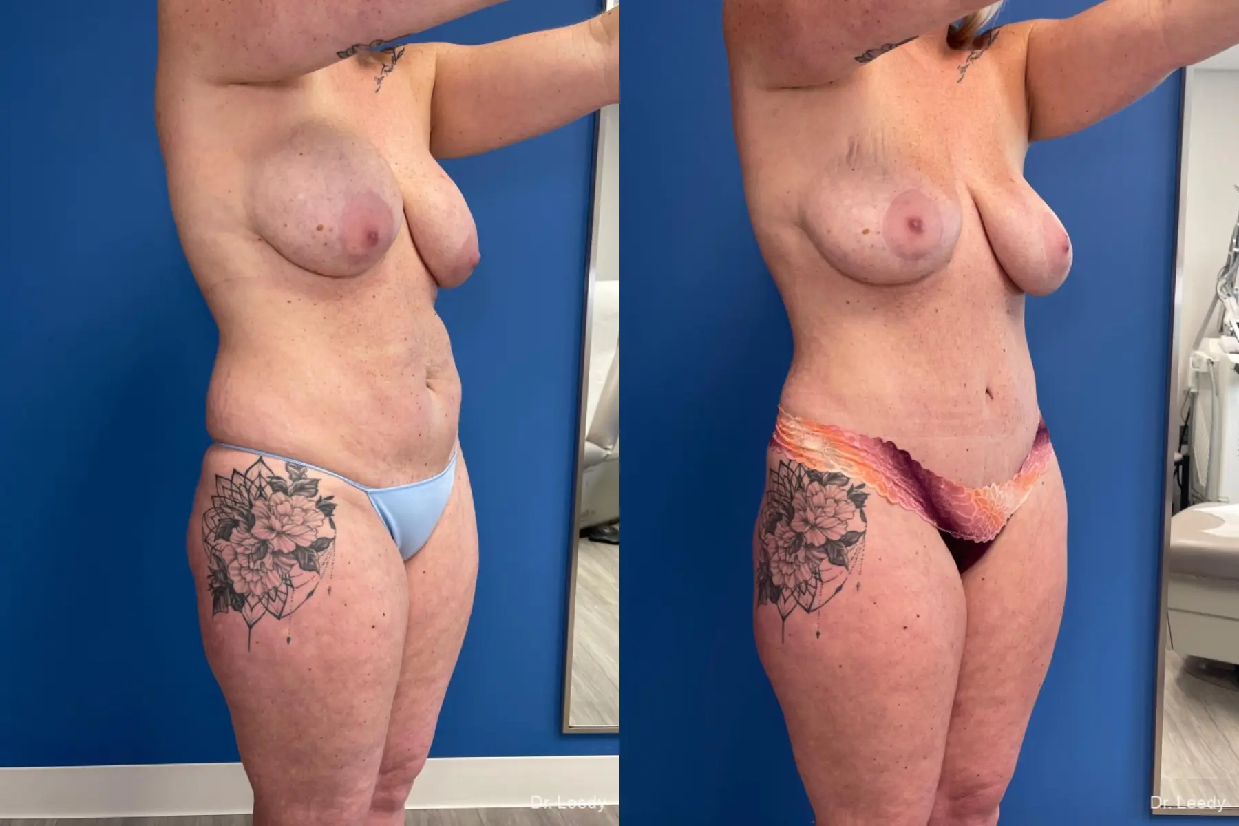 Tummy Tuck: Patient 5 - Before and After 2