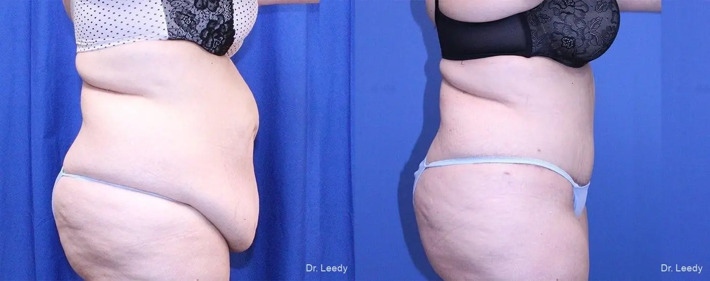 Tummy Tuck: Patient 3 - Before and After 3