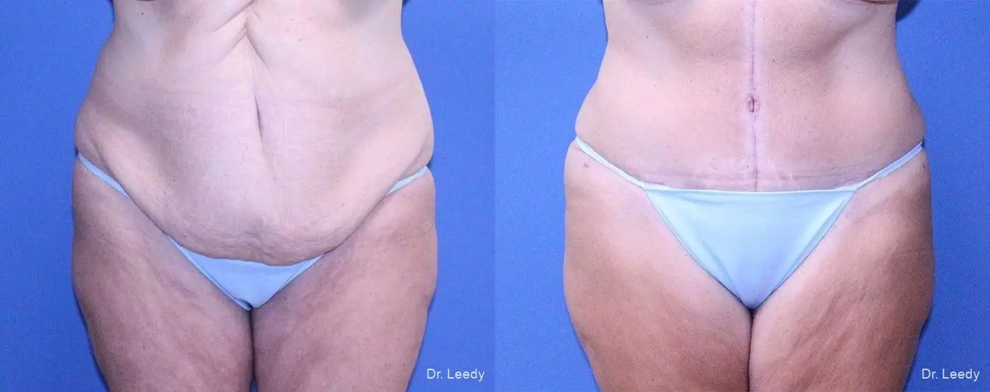 Tummy Tuck: Patient 4 - Before and After 1