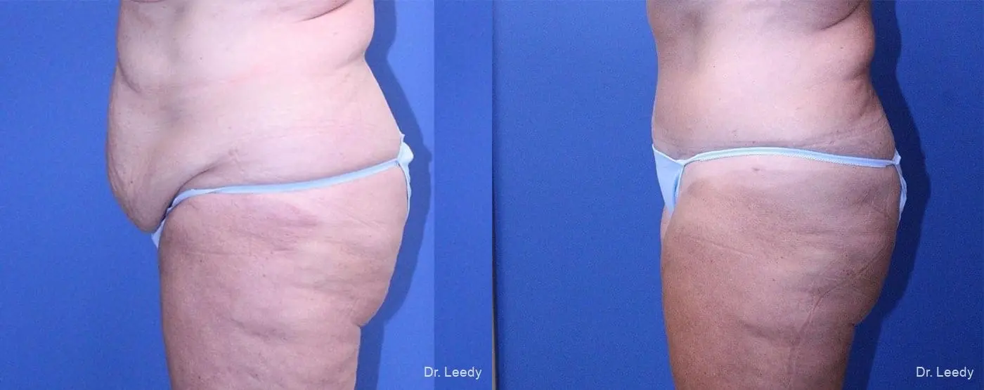 Tummy Tuck: Patient 4 - Before and After 5