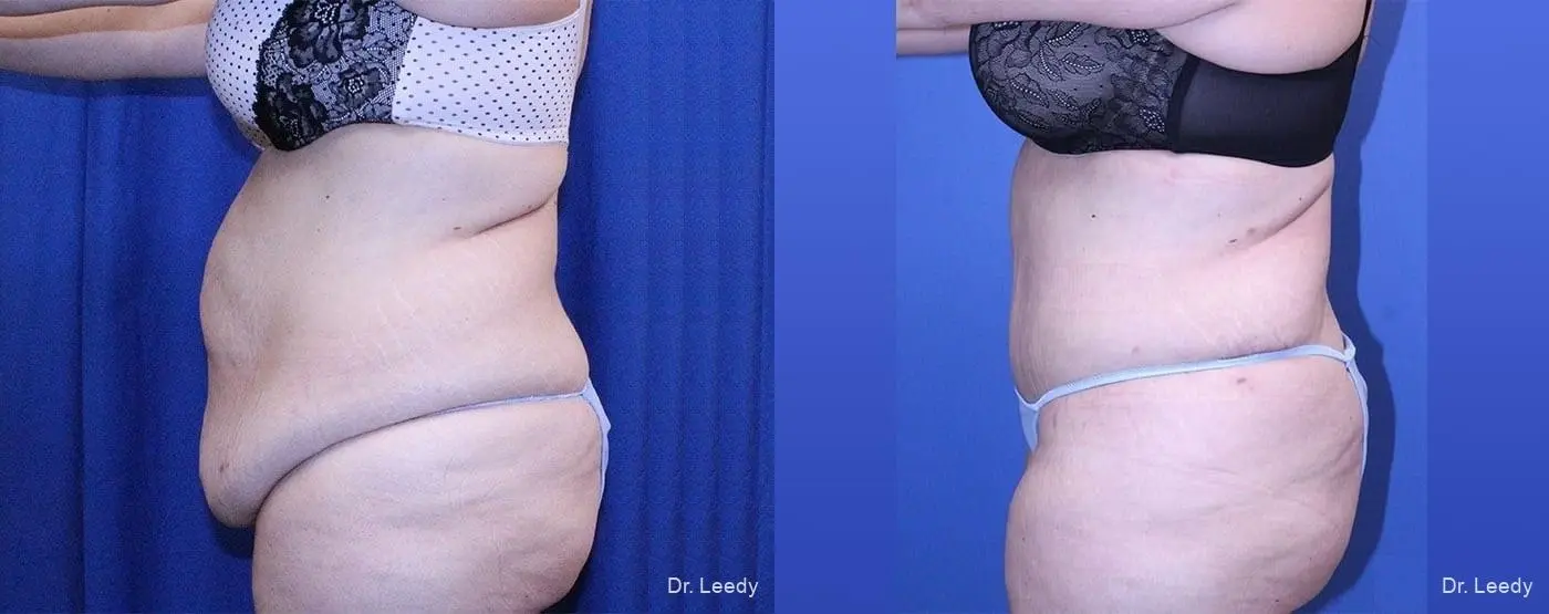 Tummy Tuck: Patient 3 - Before and After 5
