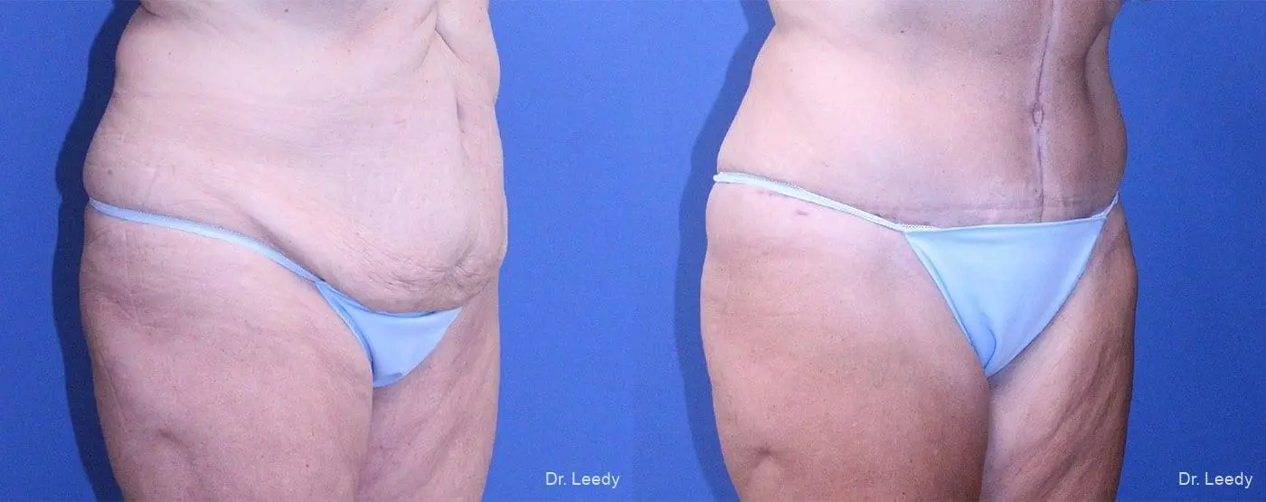 Tummy Tuck: Patient 4 - Before and After 2