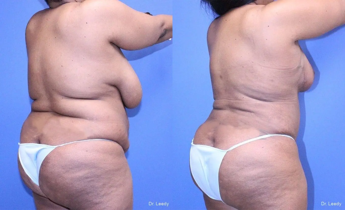 Tummy Tuck With Mastopexy: Patient 3 - Before and After 3