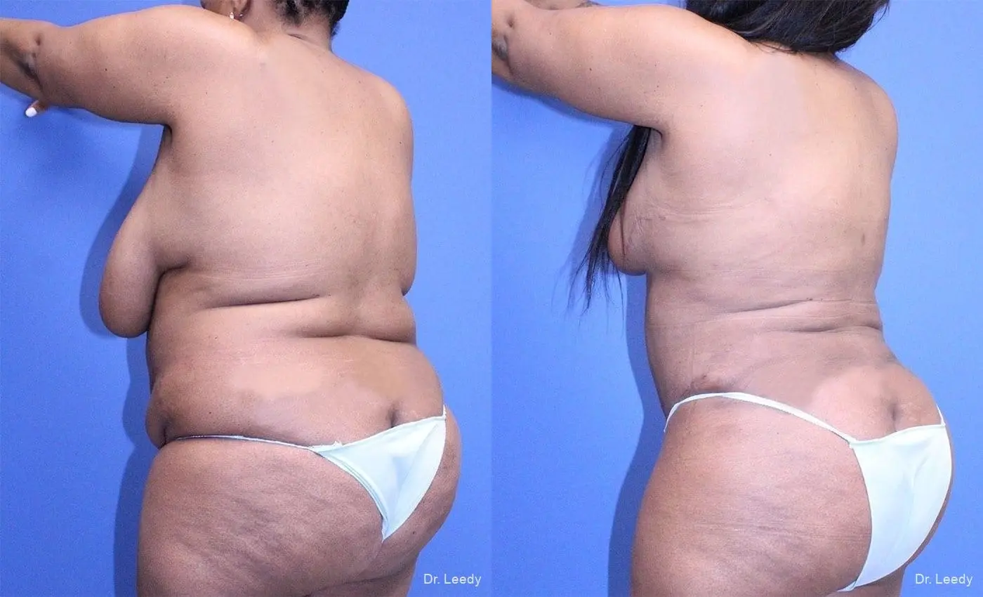 Tummy Tuck With Mastopexy: Patient 3 - Before and After 6