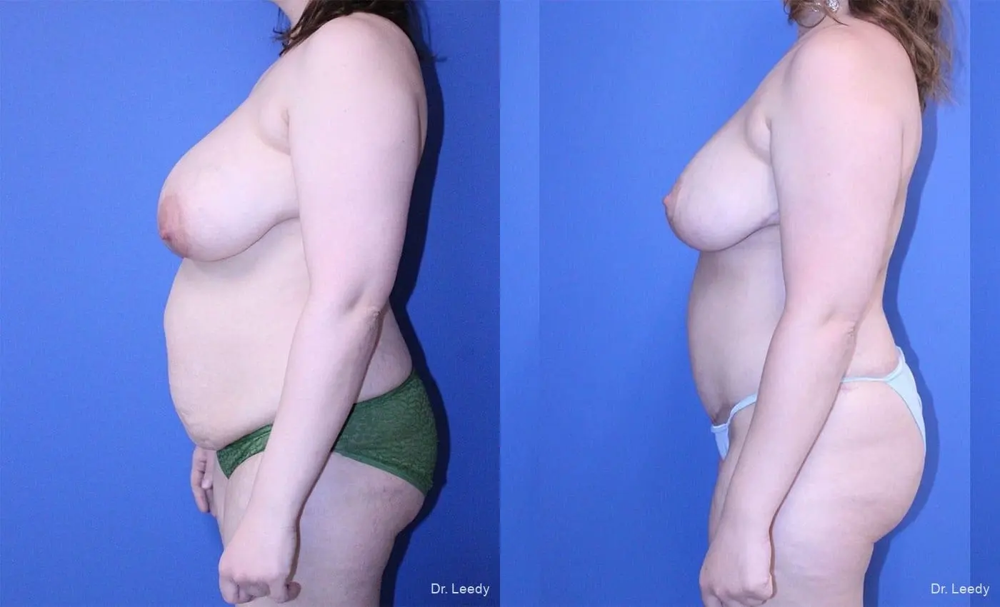 Tummy Tuck With Mastopexy: Patient 2 - Before and After 5