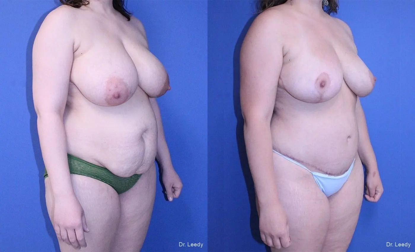 Tummy Tuck With Mastopexy: Patient 1 - Before and After 2
