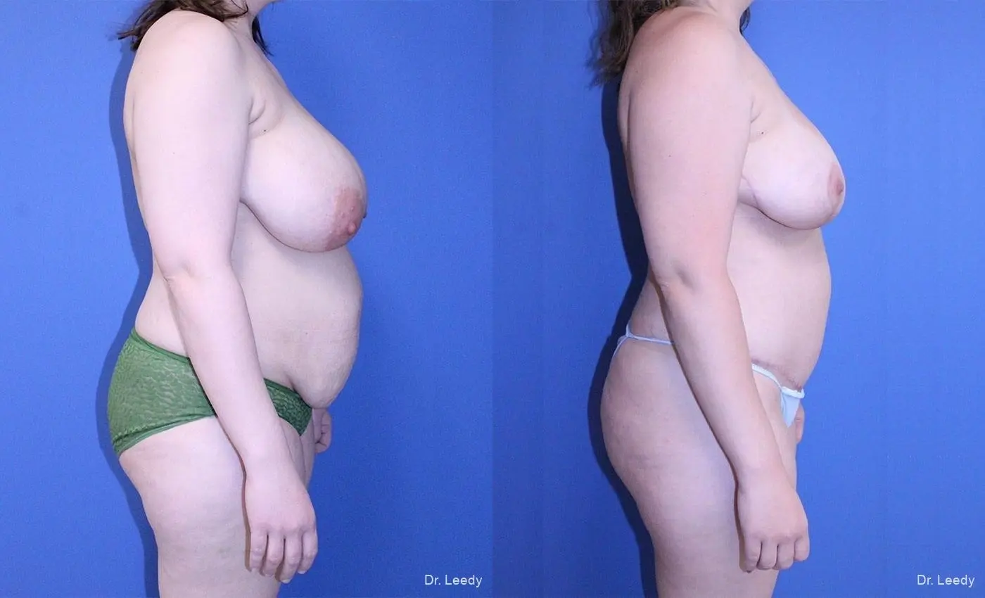 Tummy Tuck With Mastopexy: Patient 2 - Before and After 3