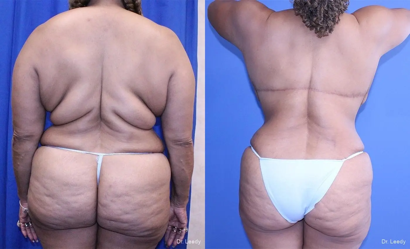 Upper Back Lift: Patient 1 - Before and After 1