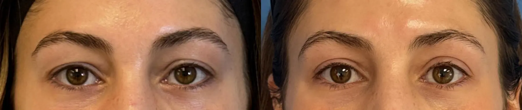 Upper Blepharoplasty: Patient 2 - Before and After  