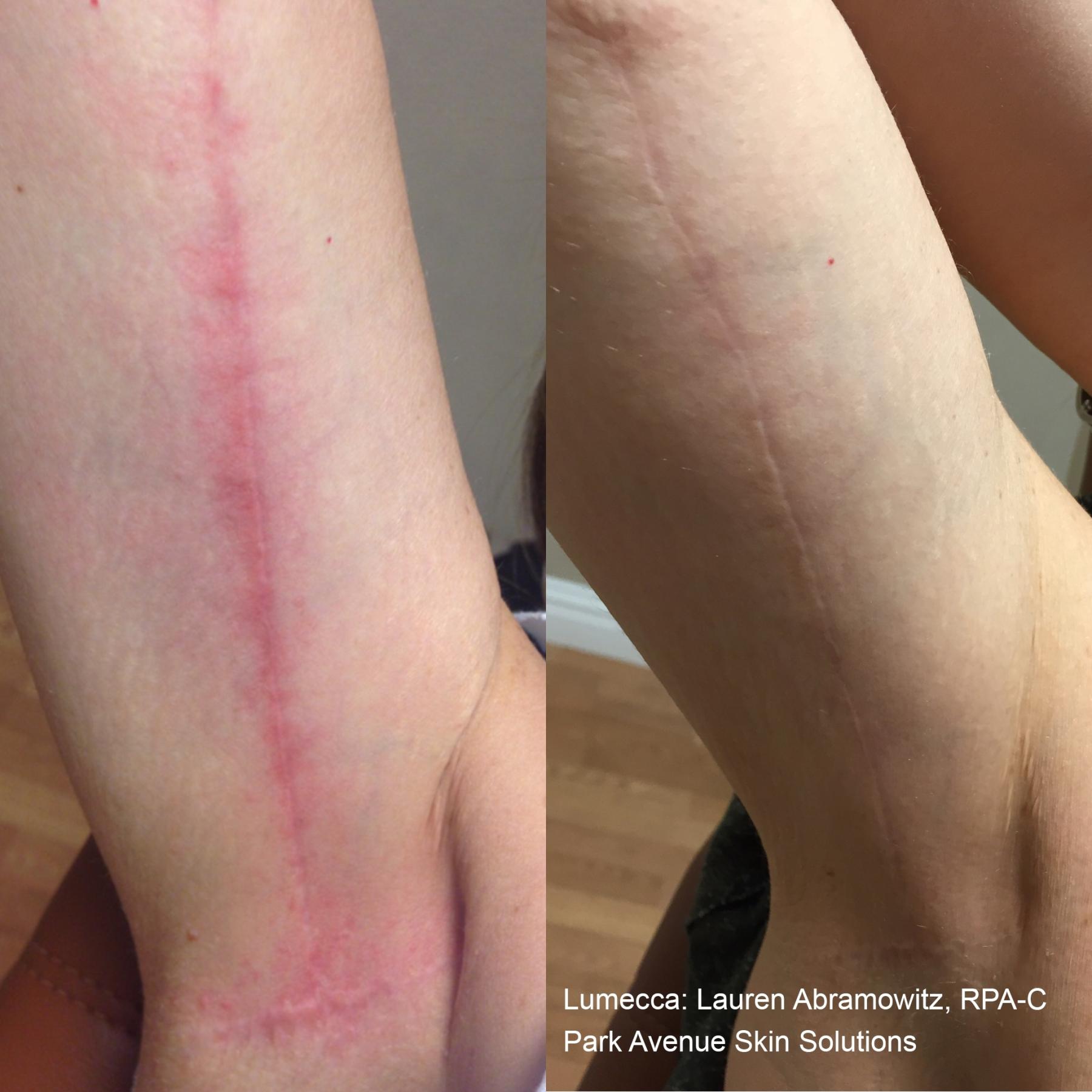 Lumecca IPL: Patient 9 - Before and After 1