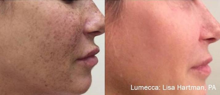 Lumecca IPL: Patient 1 - Before and After 2